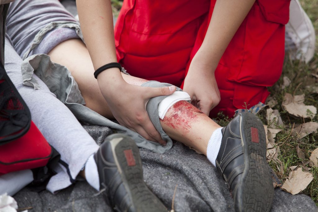 Workplace burn, second degree burns